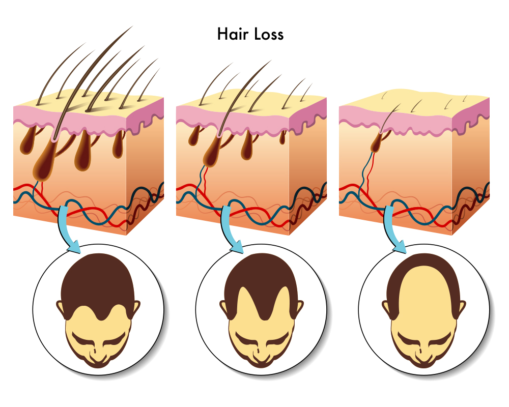 CBD לנשירת שיער: יעילות, שימוש ובטיחות
